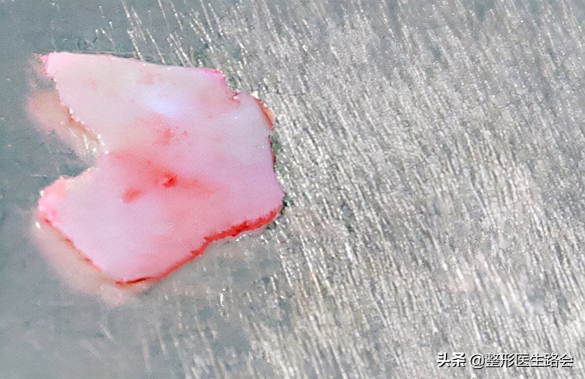 韩式隆鼻是不是就是单纯隆鼻,韩式隆鼻一般要多少钱一次案例