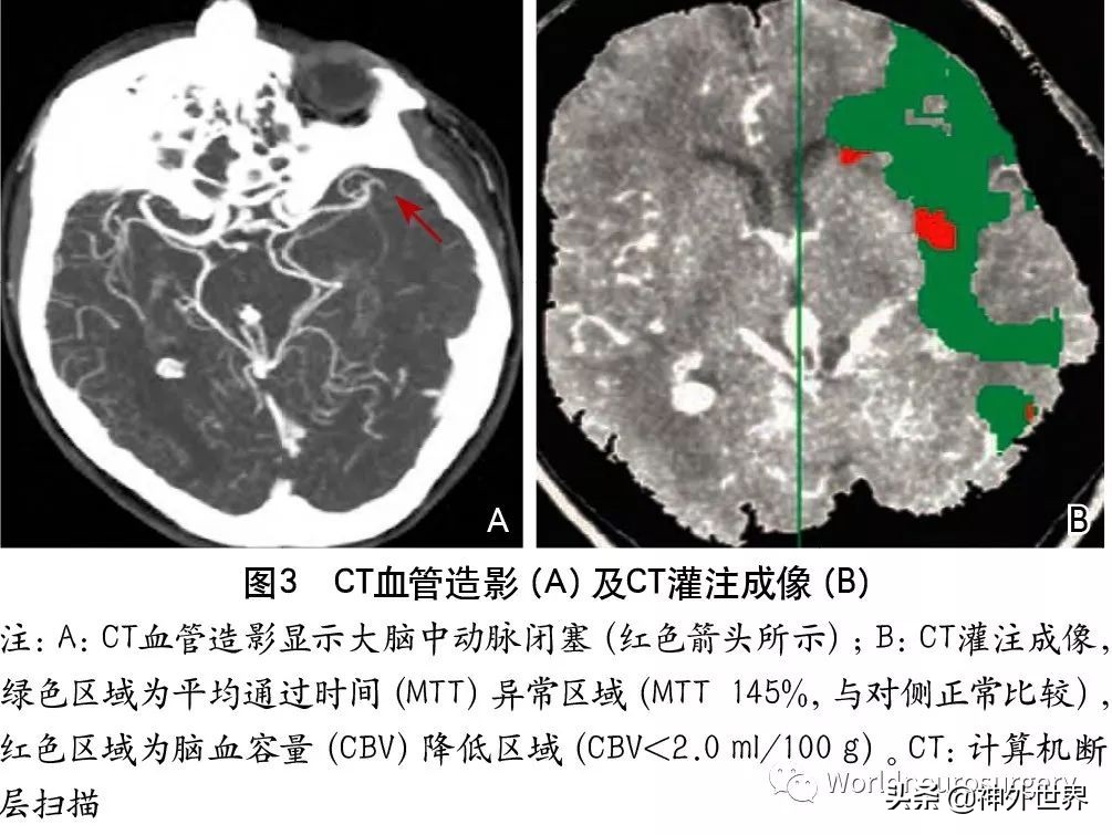 急性缺血性卒中诊治指南2023,缺血性卒中介入指南