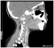 放疗不独用于癌症，治疗良性病也有奇效
