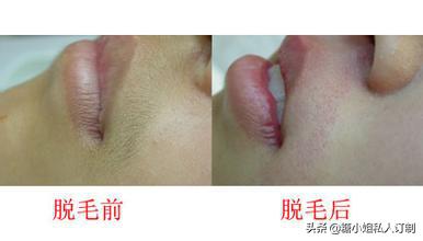 女生长唇毛怎么办简单去除,女生去除唇毛最安全有效的办法