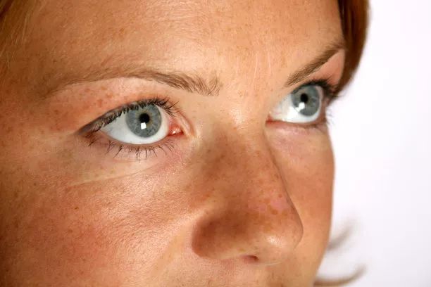 褐斑怎么祛,褐斑怎么根除