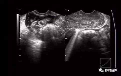 盆底超声可检查什么疾病,哪些疾病需要做妇科检查