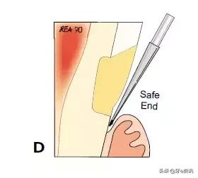 补楔状缺损的步骤,楔状缺损补牙过程