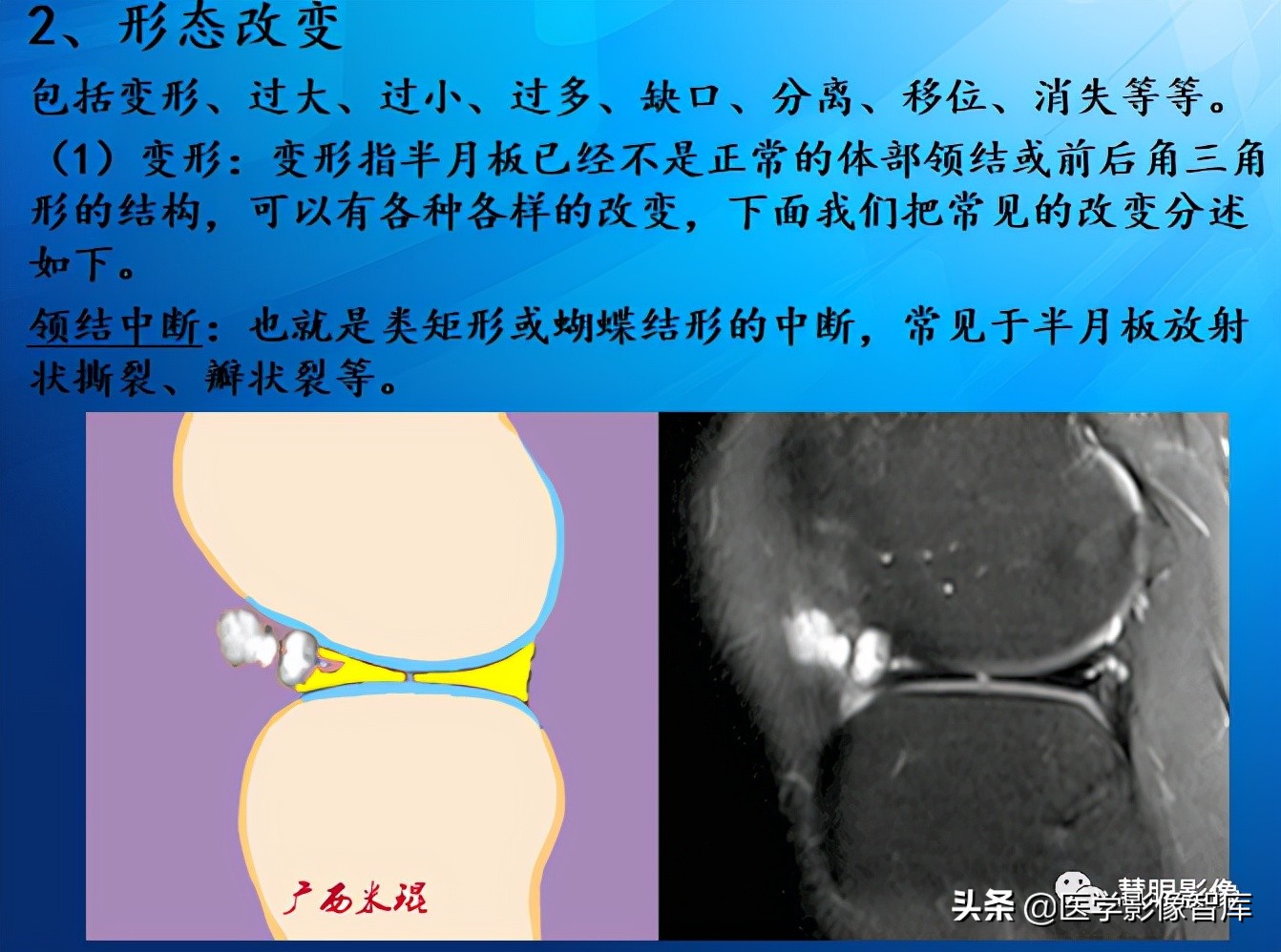 膝关节半月板损伤的解剖结构图,半月板mri解剖图解