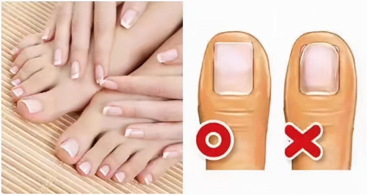 甲沟炎拔掉脚趾甲的过程,大脚趾甲重新长出来要多久