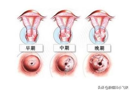 感染hpv就一定会得宫颈癌吗,hpv感染隐瞒犯法吗