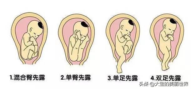 39周胎位不正能转过来吗,孕期胎位不正准妈妈莫慌张