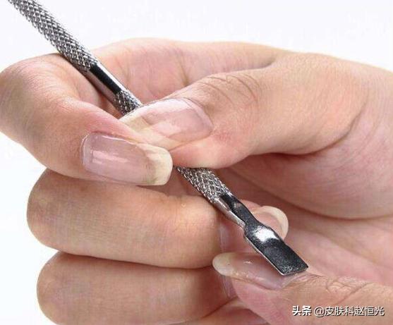 怎么预防脚上的灰指甲传染手上,灰指甲传染率高及时处理避免扩散