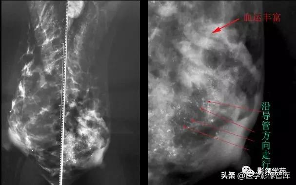 乳腺钙化怎么区分良性和恶性,乳腺钙化的诊断与分级