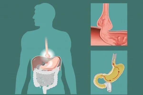 反胃烧心快速缓解,反胃烧心吃什么中药调理