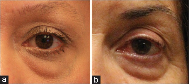 宝宝黑眼圈紫色是怎么回事,宝宝黑眼圈边缘有白边是怎么回事