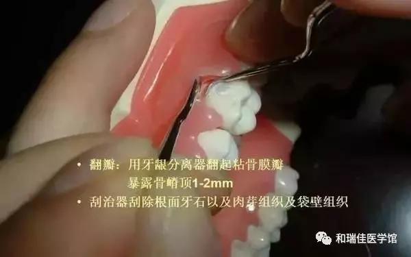 松牙固定需要什么条件,钢丝松牙固定操作流程