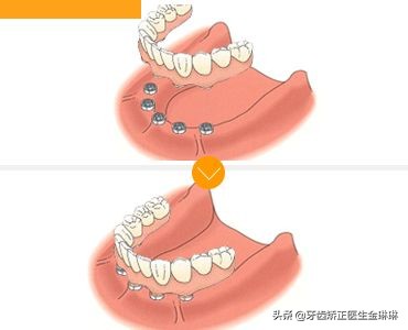 淄博市种植牙哪里最好,淄博正规种植牙推荐