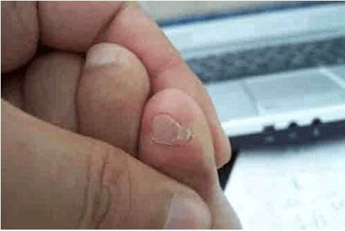 为什么小脚指甲是两瓣,小脚趾为什么有两瓣指甲