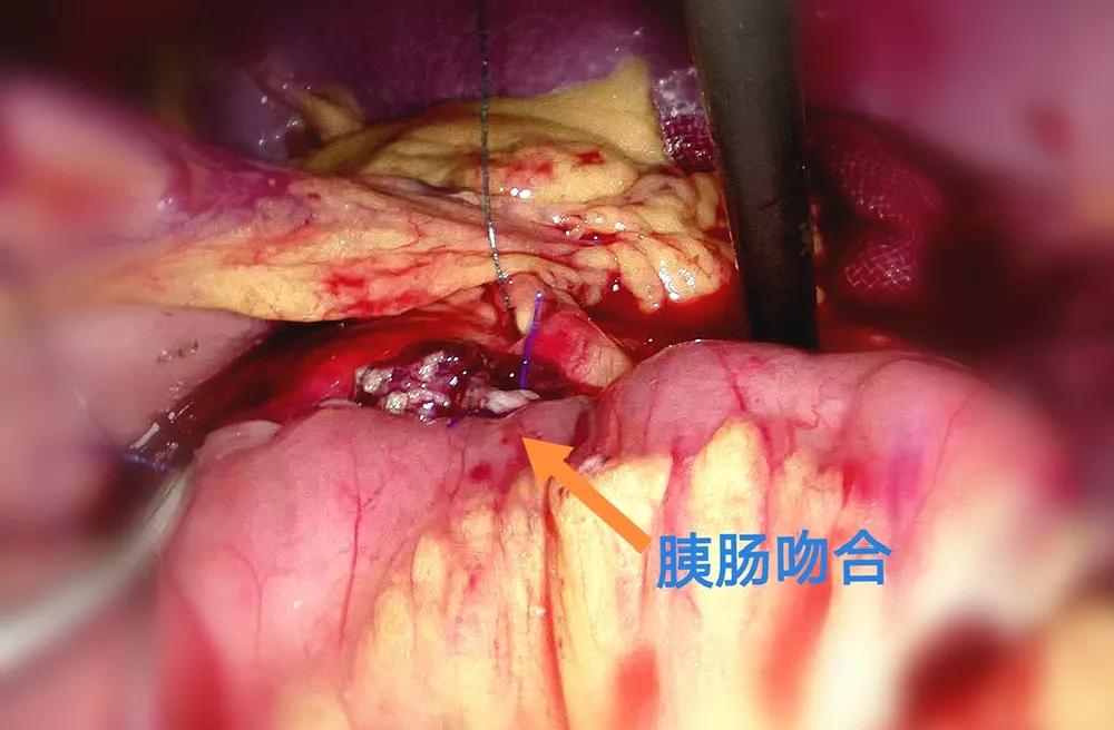 腹腔镜胰腺中段切除术的现状,腹腔镜下胰体尾部切除手术步骤