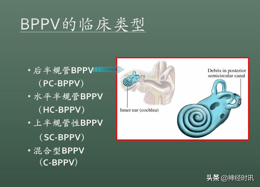 良性位置性眩晕诊断和治疗指南,良性阵发性位置性眩晕的诊断标准