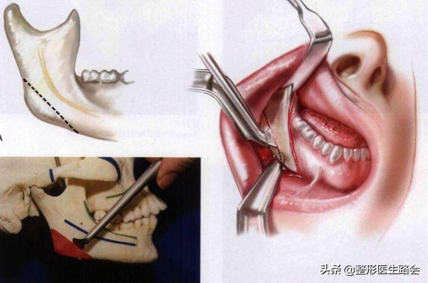 蘑菇怎么变成鹅蛋脸,国字脸磨骨成瓜子脸多少钱