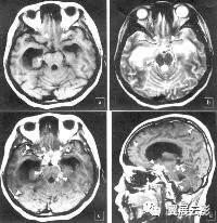 脑脓肿增强扫描是环形强化吗,脑部脓肿