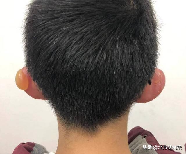 男童户外“光头”踢球致二度冻伤，这些事别不以为意