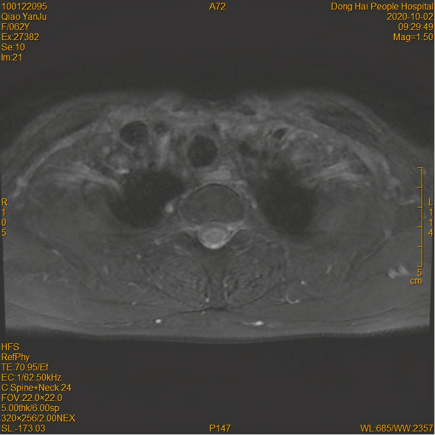 为什么鼻咽癌首选放疗,为什么鼻咽癌首选治疗方式是放疗