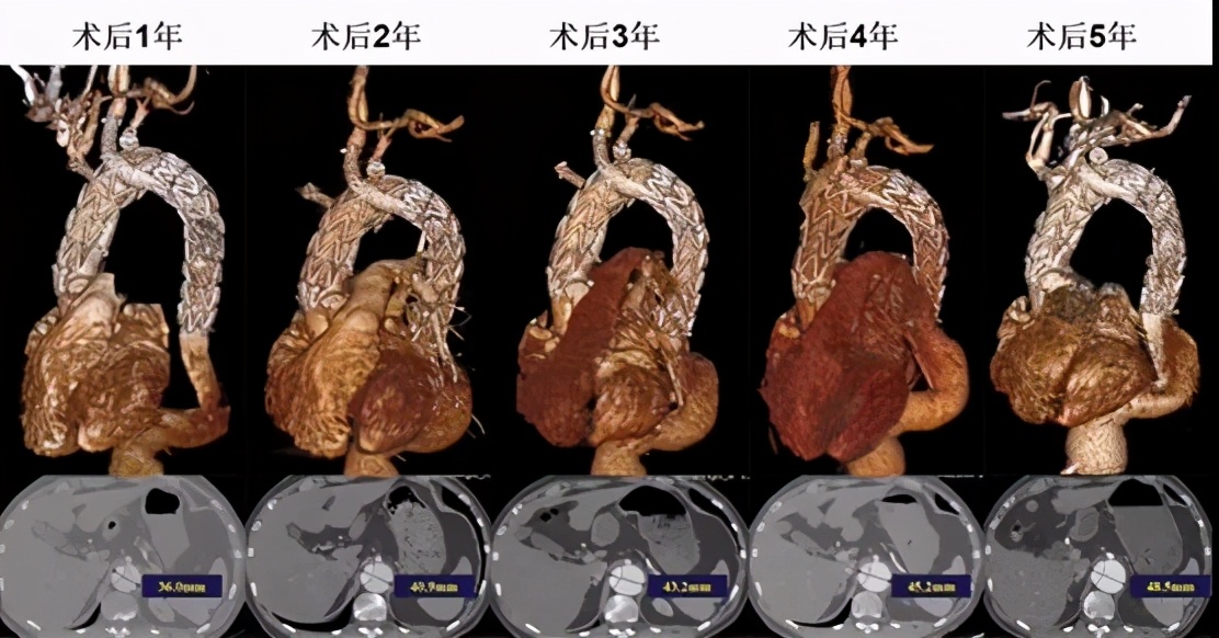 胡佳:升主动脉近端手术后新发弓部病变的腔内治疗
