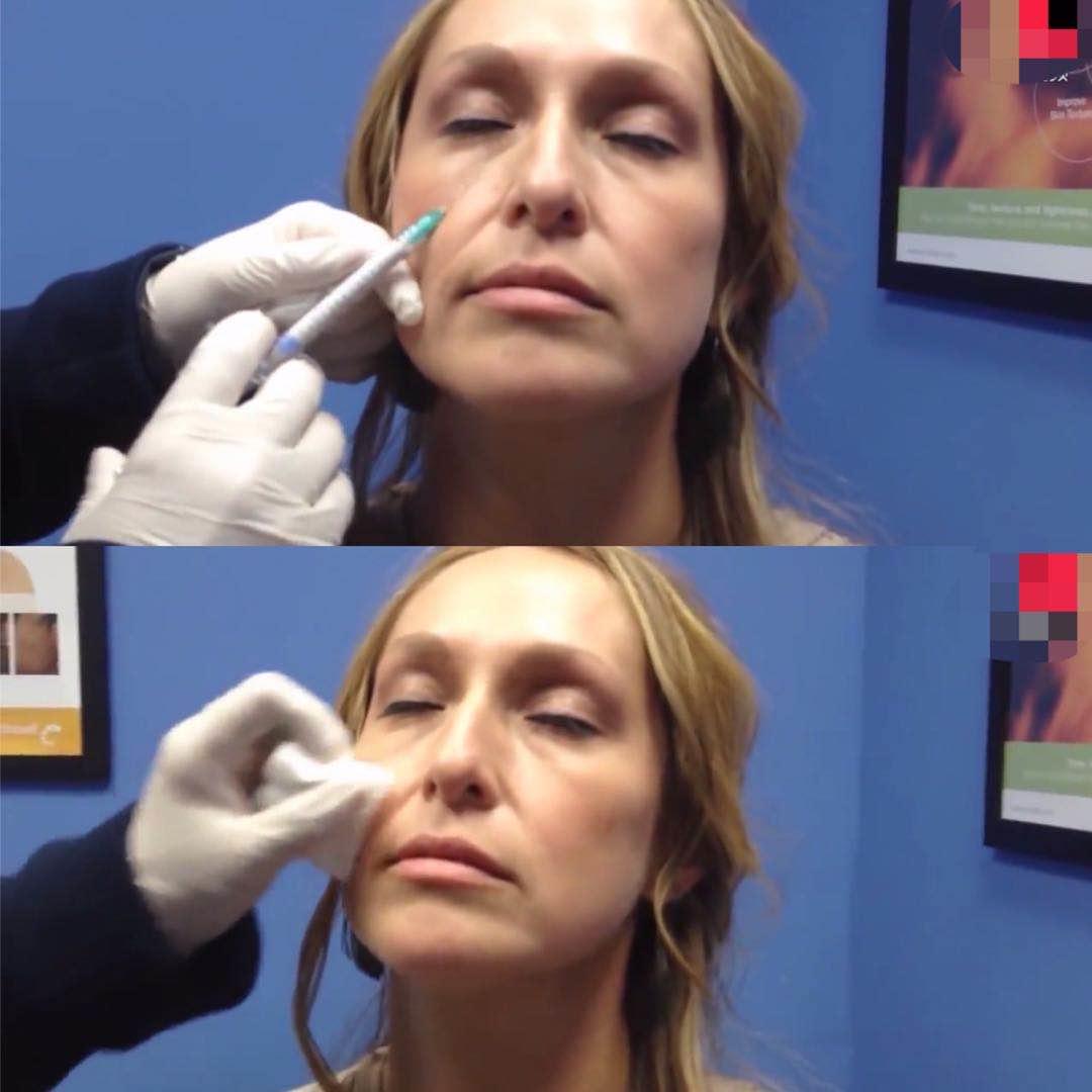 79岁英国一富婆为“除皱”，连打30年玻尿酸抗老，如今长啥样了？