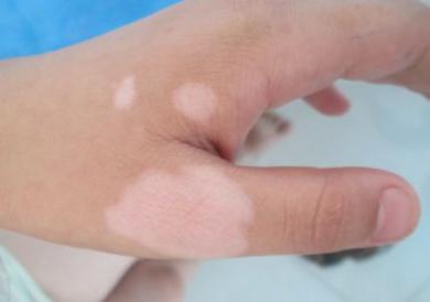 小女孩得白癜风是因为环境影响吗,7岁女童被查出白癜风