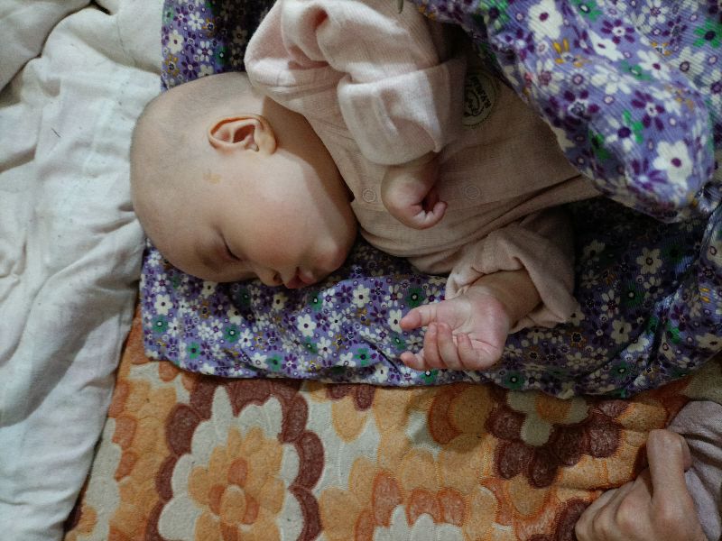 宝宝反复湿疹要崩溃了,湿疹宝宝一定是过敏体质吗