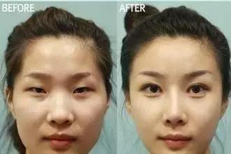 网红眼睛开眼角,做过开眼角的网红