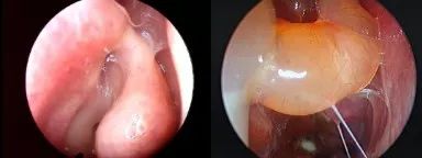 慢性鼻窦炎药物治疗原则,慢性鼻窦炎初步诊疗措施