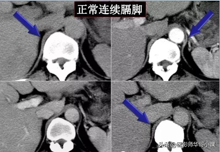 「精品课件」胸部膈肌的解剖及常见病变影像的表现