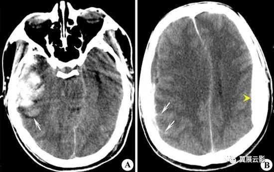 脑部脓肿怎么治疗,多发性脑脓肿能自愈吗