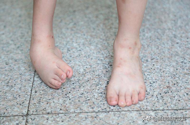 足外翻如何按摩腓骨长肌儿童,足外翻怎样调整腓骨长肌