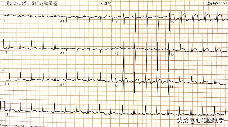 心脏肿瘤转移了还能手术吗,心脏肿瘤转移到肺