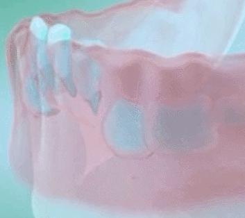 恒牙出来多久了乳牙未掉需要拔牙,孩子乳牙未掉用干预吗