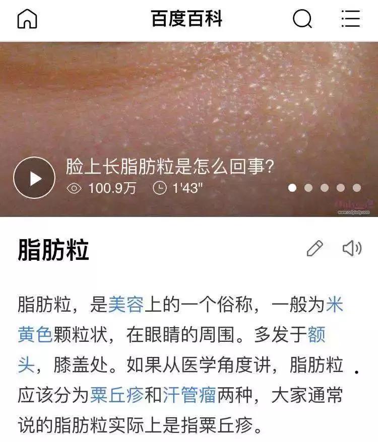 去黑头粉刺闭口最有效的方法,黑头闭口粉刺怎么彻底去除