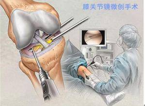 关节镜对膝骨性关节炎的效果如何,骨性关节炎做关节镜手术效果好吗