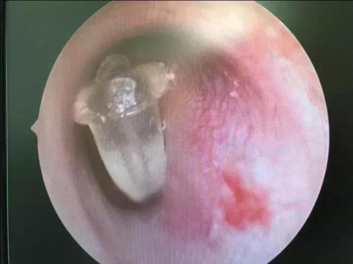 小孩耳朵长肉芽是什么原因引起的,耳朵里长了个肉芽怎么回事