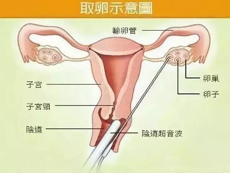 不打麻醉的女人剖腹产,女生不打麻药穿刺痛哭