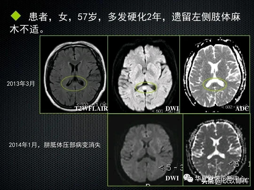 颈椎病脊髓变性mri表现,脊髓亚急性联合变性的诊断