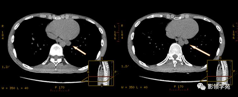 纵隔和肾上腺恶性肿瘤,纵隔性肿瘤位置图