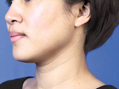 有了颈纹是衰老的标志,为什么有颈纹就显老