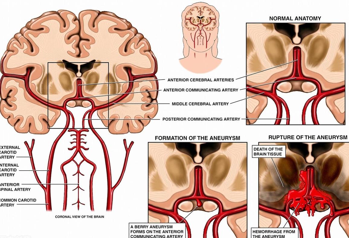 低颅压综合症,低颅压性头晕症状