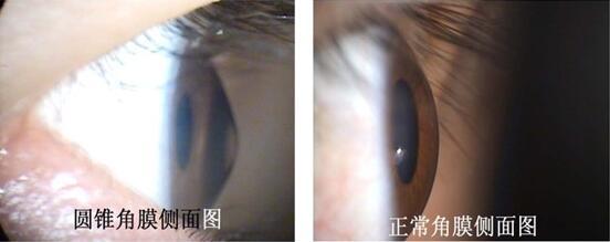 圆锥角膜一般度数是多少,圆锥角膜几岁能查出来