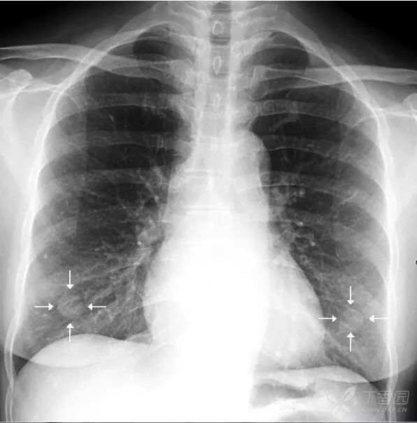 正常胸片图片,正常的胸片讲解