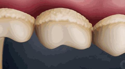 牙套要不要戴久一点再摘,牙套戴多久才不刮嘴