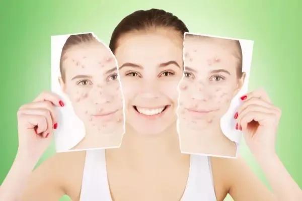 痘印怎么去除最有效的方法知乎,痘印怎么去除效果最好