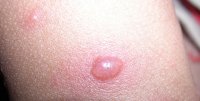 疫苗相关问答,水痘疫苗流程