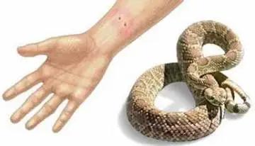 别慌，遇到蛇咬伤要这样处置！