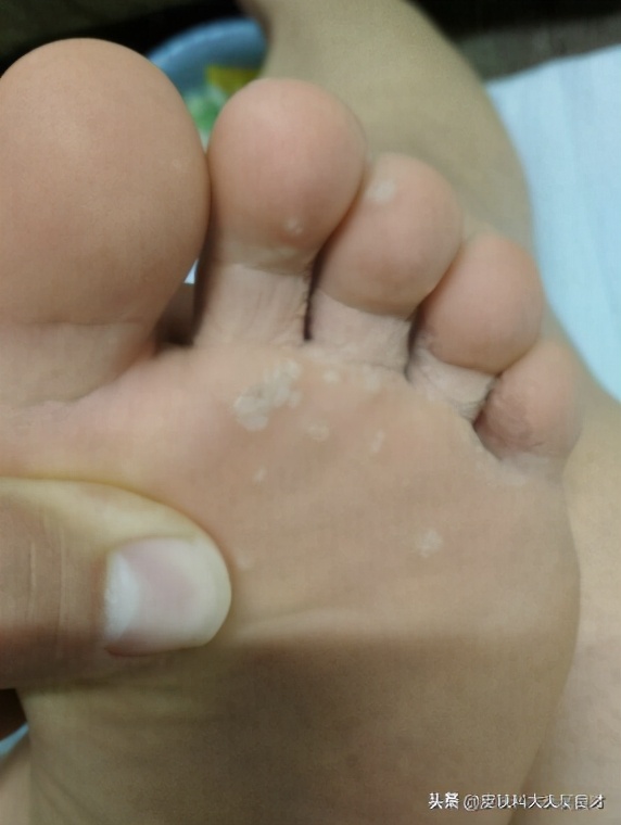 看完这篇文章后学到了什么,鸡眼和跖疣最简单的区别